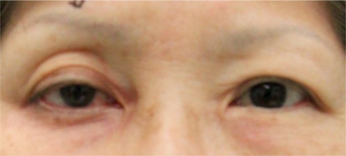 Figure 1 Preoperative clinical photo of patient’s eyelids.