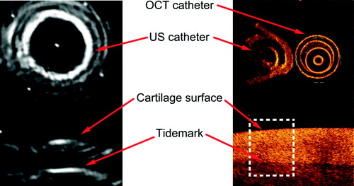 Figure 3. US TOF was determined from the US image as the time distance between the phantom or cartilage surface and the phantom-metal interface or the tidemark. Thickness of phantom and non-calcified cartilage was determined from the OCT image as the mean thickness inside a 1-mm-wide window (dashed line) under the US catheter.