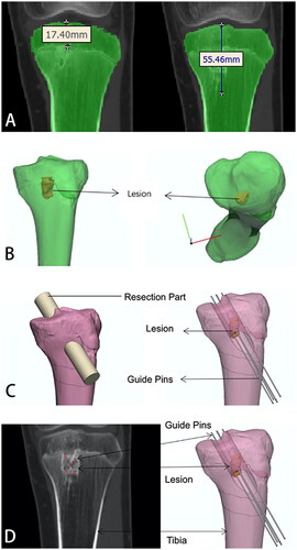 Figure 5. (A) The extent of lesion area in CT data; (B)Lesions reconstructed in three dimensions according to CT data; (C) Simulated needle placement according to the lesion; (D) Comparison of CT data and the three-dimensional model to determine the position of guide steel needle.