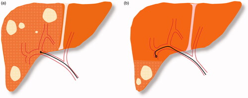 Figure 1. (a) Lobar Y90 administration in multifocal lesions. (b) Segmental Y90 administration in lesions confined to two or fewer hepatic segments.
