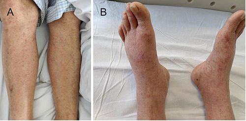 Figure 1 Erythematous rashes scattered on the legs and feet (A and B).