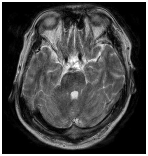 Figure 1 T2-weighted magnetic resonance imaging findings.