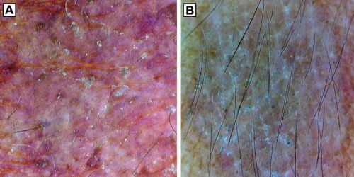 Figure 6 Dermoscopy (original magnification 10×) showing diffuse scaling pattern in cases of (A) chronic renal failure and (B) systemic lupus erythematosus taking oral corticosteroids.
