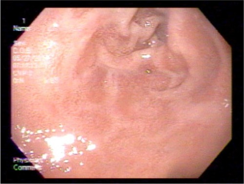Figure 3 Upper endoscopy 1 year after radiofrequency ablation.
