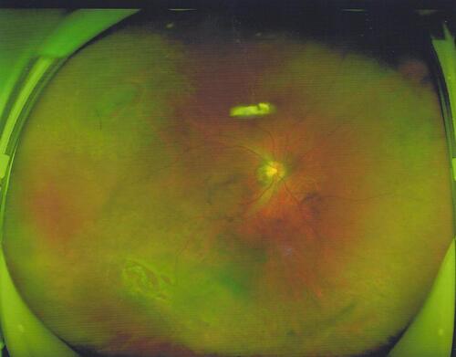 Figure 1 The inferior retinal detachment with causative inferior breaks and multiple peripheral breaks that have been photocoagulated.