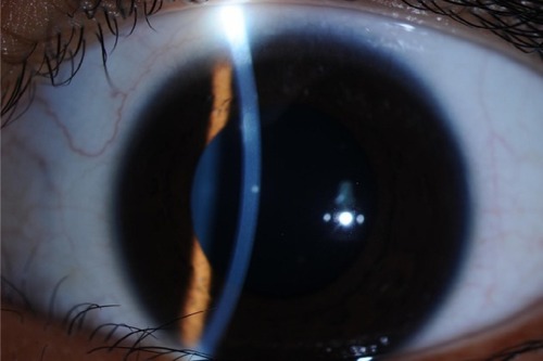 Figure 3 Twelve months after the initial visit, there is slight corneal opacity in the patient’s right eye.