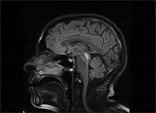 Figure 1. Hypersignal change in dorsal midbrain in mid-sagittal FLAIR.