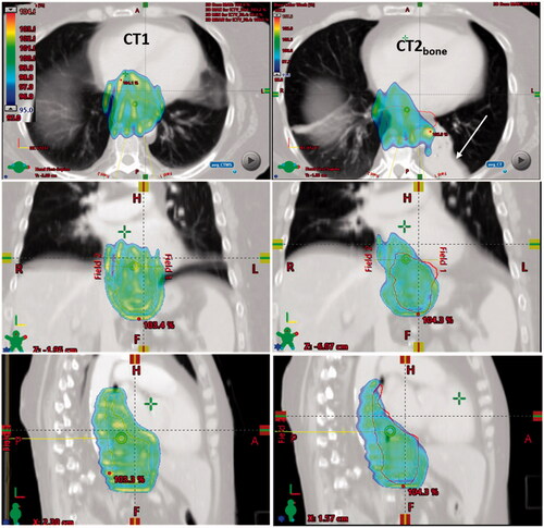 Figure 5. CT images, delineations and dose distributions for patient 35. Doses above 95% of prescribed dose are shown with dose colour wash for the PT plan. Orange and red contours represent the iCTV delineated on CT1 and CT2bone, respectively. An atelectasis appeared at CT2 at fraction five resulting in target under-dosage of bone match.