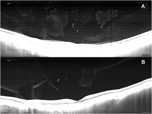 Figure 3 (A) A PVD was identified by ultrasound, however the SS-OCT revealed adhesions of the vitreous at the fovea and the optic nerve head. The optically empty pockets seen within the vitreous of the SS-OCT image may represent a situation that is not easily identified with ultrasound. (B) SS-OCT revealed a small residual adhesion of the vitreous to the optic nerve head that was not identified by ultrasound.