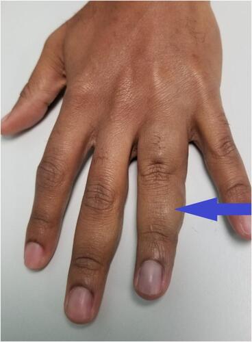 Figure 2 Dorsal view showing edema (purple arrow) of the middle phalanx of the finger.