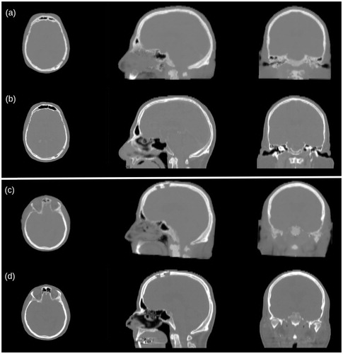 Figure 3. Visual comparison between pCT (a and c) and CT (b and d) for two representative cases. The zygomatic and frontal bones and the sinus cavities are most affected by wrong HU reassignment (c and d). The surgical holes present in the posterior left region of the skull (a and b) are satisfactorily reconstructed.