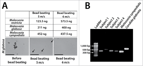 Figure 3. Examples of technical challenges important in the molecular evaluation of oral fungi. Table in Panel A shows yields after DNA extraction of standardized Malassezia cell suspensions (5 × 107 cells) using slightly different bead-beating speeds. DNA was extracted using yttria-zyrconia beads following a protocol developed by our group.Citation5 Samples were subjected to bead-beating (3 × 30 sec) in an MP Biomedicals FastPrep™ instrument using a speed of 5 m/s or 6 m/s. Notice that this small variation almost doubled DNA recovery for M. restricta and M. globosa while it did not affect DNA yield for M. sympodialis. Arrows in middle phase-contrast micrograph show intact M. globosa cells after bead-beating using the 5 m/s setting. Scale bar = 50 μm. Panel B shows dramatic differences in amplicon length in the ITS1 region. Amplicons were generated from saliva samples of 4 subjects and from 2 reference strains using a published protocol.Citation5 Such variation in amplicon length may introduce bias in abundance estimates as shorter fragments are preferentially sequenced.