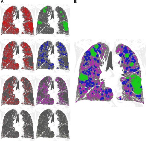 Figure 4 Iterative process of size-based emphysema clustering.