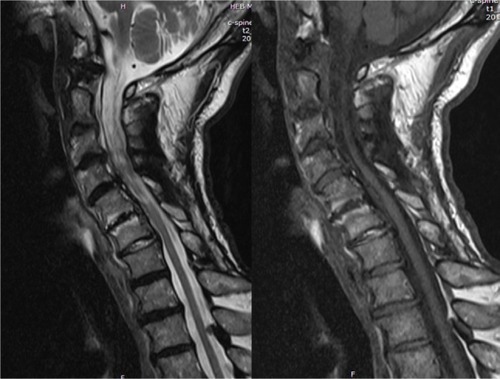 Figure 3 Sigmoid type cervical kyphosis with Modic-2 changes in C5–C6.