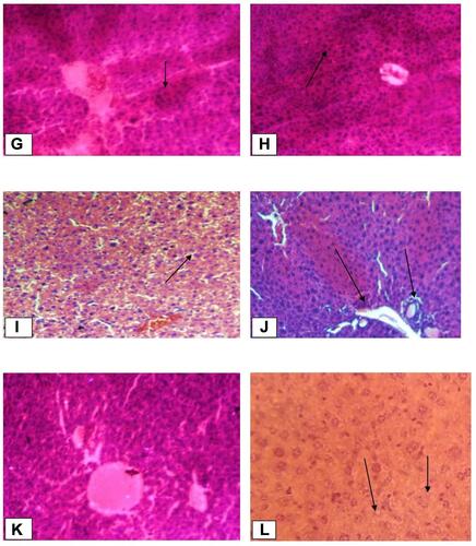 Figure 1 Histopathological changes of liver tissues (10x and 40x). (A) Normal control group (Normal hepatic cells with normal liver architecture) (B) paracetamol group (Necrotic hepatocytes, severe degeneration, hyperaemic/condensed blood vessels and cells with inflammation); Black arrow shows damaged hepatocytes. (C) Standard group (Liver architecture normal, cells with mild inflammation); Black arrow shows normal hepatocytes (D) Crude extract 100 mg/kg (Aggravated necrotic cells); Black arrow shows necrotized cells. (E) Crude extract 200 mg/kg (More necrotic hepatocytes and regenerated cells); Black arrow shows regenerated cells. (F) Crude extract 400mg/kg (Hepatocytes are normal in appearance with some mitotic figures); Black arrow shows normal hepatocytes. (G) Aqueous fraction 100mg/kg (Necrotized cells are by far more than normal cells); Black arrow shows necrotized hepatocytes. (H) Aqueous fraction 200 mg/kg (Normal hepatocytes are fewer than in Aqueous fraction 400mg/kg and haemorrhage); Black arrow shows haemorrhages. (I) Aqueous fraction 400 mg/kg (Most cells are normal with some dead cells and regenerated cells); Black arrow shows regenerated cells. (J) Chloroform fraction 100mg/kg (Shows inflammation and degeneration of hepatocytes); Black arrow shows degenerated cells. (K) Chloroform fraction 200 mg/kg (Mild inflammation and degeneration; regeneration). (L) Chloroform fraction 400mg/kg (Almost normal hepatocytes with mitotic figures); Black arrow shows normal hepatocytes.