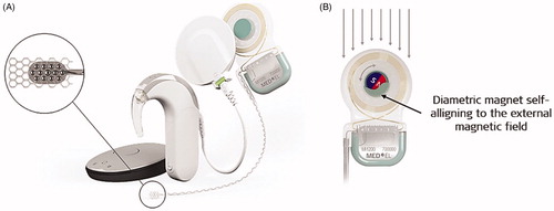 Figure 18. SYNCHRONY ABI system showing both single unit and BTE audio processor (A). The implant has a 1.5 T conditional MRI compatible magnet that self-aligns to the external magnetic field (B) (image courtesy of MED-EL).