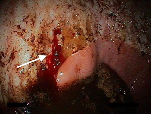 Figure 7 Bleeding ulcer (white arrow). Ulcers may be associated with active hemorrhage when severe. Image property of the author.