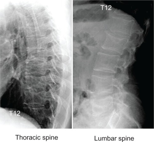 Figure 4 Radiographs of thoracic and lumbar spine.