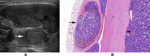 Figure 3 (A) Follicular thyroid carcinoma of the left thyroid in a 23-year-old female. Longitudinal sonogram shows a hypoechoic nodule with a hypoechoic satellite nodule (arrow). (B) Follicular thyroid carcinoma in a 65-year-old woman. Photomicrograph shows a thick and hyalinized capsule (arrowhead) and a satellite nodule with a secondary limiting fibrous band (arrow) (H and E, × 100).