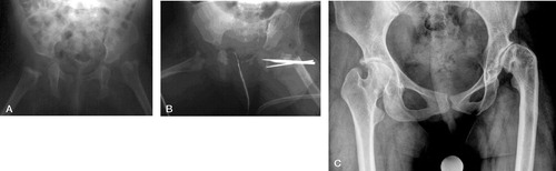 Figure 2. Patient no 2. A. Preoperatively, showing a luxated hip without any signs of a femoral neck and femoral head in the left hip. B. After trochanter arthroplasty and subtrochanteric osteotomy fixated with Steinman pins. Note severe acetabular dysplasia. C. 21 years after trochanter arthroplasty. The femoral head is flattended and poorly covered by the acetabulum. Osteoarthritic changes are present.