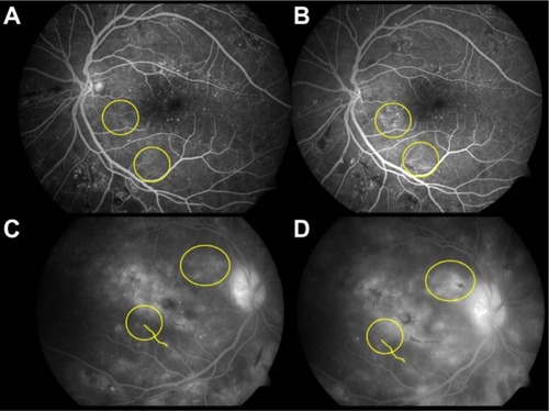 Figure 1 Characteristic differences in the phenotype of diabetic retinopathy (DR) in two patients.