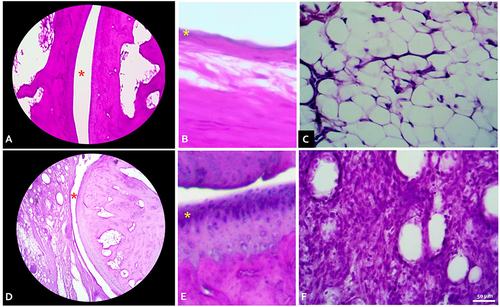 Figure 3 Histology findings in normal ankle (A–C) vs grade 3 severely arthritic ankle (C and D) with Hematoxylin-Eosin staining. (A) Talo-tibial joint space (red asterisk) in normal ankle, total magnification (TM) 40x. (B) Healthy synovium consisted of 1–2 of synovial cell linings (yellow asterix). TM 100x. (C) Synovial connective tissue showed no infiltration of inflammatory cells. TM 400x. (D) Joint space was markedly reduced with irregularity of the articular cartilage. TM 40x. (E) Synovial cells hyperplasia (yellow asterix). TM 100x. (F) Dense inflammatory cells infiltrate in synovial connective tissue. TM 400x.