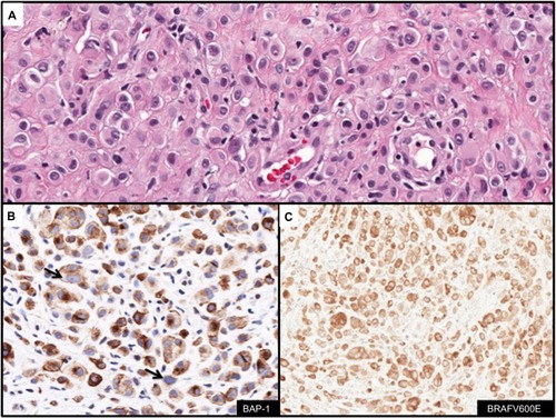 Figure 7 Immunohistochemcial evaluation of BAP-1 and BRAFV600E status in melanocytic lesions.