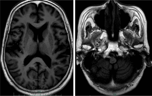 Figure 1 Images from the first cranial MRI scanning of our patient.