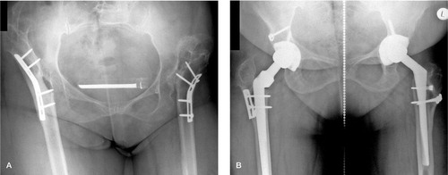 Figure 1. A 54-year-old woman who had high congenital dislocation of both hips. At the age of 17, she had undergone a bilateral high-seated Schanz osteotomy to reduce limp. A. Preoperatively. B. 9 years after a cementless total hip arthroplasty of the left hip and 8 years after a similar procedure on the left hip. Both hips underwent femoral shortening and advancement of the greater trochanter. The leg-length discrepancy was 1 cm (the left side being shorter). There were no radiographic signs of loosening of the components and no signs of polyethylene wear.