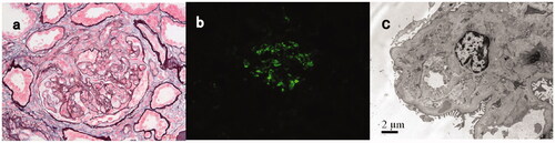 Figure 2. Light, immunofluorescence, and electron microscopy findings in a C3GN patient with TMA-like lesions (patient #17). (A) Light microscopy showed a mesangial proliferative pattern of injury with endocapillary hypercellularity and segmental sclerosis (Periodic acid-silver methenamine + Masson trichrome staining, B × 400). (B) Immunofluorescence studies showed bright C3 in the mesangial and along segmental capillary walls (×400). (C): Electron microscopy showed electron-dense deposits in mesangial and intramembranous regions and subendothelial edema with narrowing of the capillary lumen (×8000).