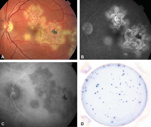 Figure 2. Patient with presumed intraocular tuberculosis and serpiginous choroiditis. A: Fundus photography showing white dots at the choroid, in the posterior pole of the left eye. B: Fluorescein angiography showing hyperfluorescence at the rim of the lesions and hypofluorescence in the center of the lesions. C: Indocyanine angiography showing hypofluorescence of the lesions. D: Highly positive T-SPOT®.TB test (panel B, CFP-10 = 57 spots).