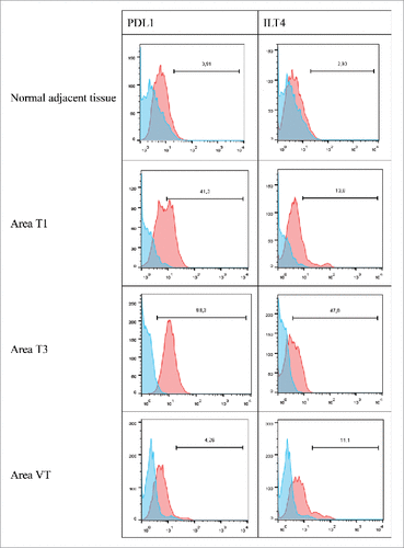 Figure 6. Representative histograms obtained by flow cytometry analysis for PDL1 and ILT4 cell-surface expression on cells from the normal adjacent tissue or on tumor cells from 3 different tumor areas in patient #10 are shown. Cells were obtained after mechanic disruption followed by enzymatic digestion of either the normal adjacent tissue or 3 different areas from the surgically-resected tumor (T1,T3, VT). Cells were then cultured for 3 d and then stained with antibody either directed against CD3, CD45, PDL1 or ILT4 marker. Tumor cells were considered to be large CD45-negative and CD3-negative cells (data not shown). Percentage of the HLA-G-positive population in CD3- CD45- gated cells is indicated. Blue and red histograms correspond to staining with isotype control and marker, respectively. VT, tumoral thrombus of the renal vein.