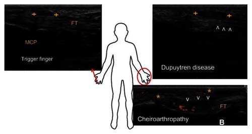 Figure 2 Examples of ultrasound appearances of tendon and fascia abnormalities in the hand.