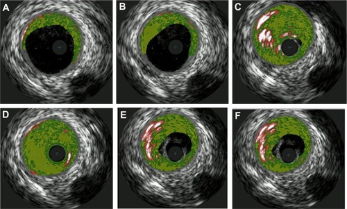Figure 4A–F Coronary ultrasound showing vessel walls with mild plaque disease and thrombus lodged in vessel walls of LAD appreciated especially in (C) and (D).