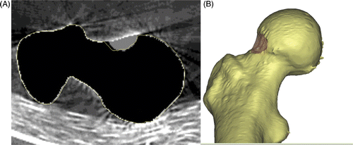 Figure 5. In vitro evaluation of computer-assisted surgical accuracy. (A) Axial CT reconstruction of the planned (grey area) versus actual (yellow outline) resection of a cam-type lesion in a sawbone model; and (B) 3D reconstruction of the postoperative result.