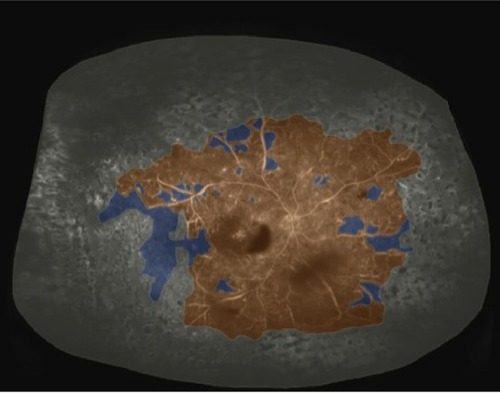 Figure 4 Widefield FA after completion of targeted retinal photocoagulation.