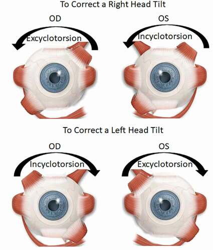 Figure 6. To correct a right head tilt: A nasal transposition of the right superior rectus and left inferior rectus and/or temporal transposition of the right inferior rectus and the left superior rectus leads to excyclotorsion of the right eye and incyclotorsion of the left eye respectively. To correct a left head tilt: A nasal transposition of the right inferior rectus and left superior rectus and/or temporal transposition of the right superior rectus and left inferior rectus leads to incyclotorsion of the right eye and excyclotorsion of the left eye respectively. Reproduced with permission from De Castro-abeger et al. [Citation106]