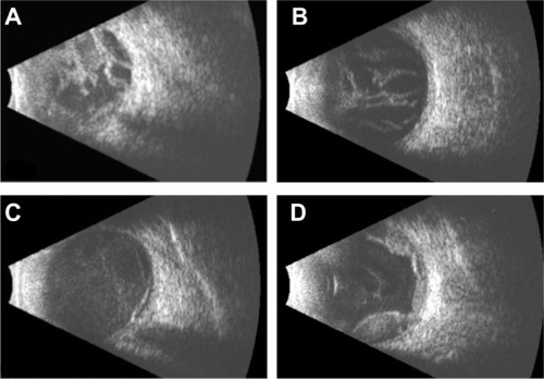 Figure 1 Representative echographic features of (A) dense vitreous opacities with retinal and choroidal detachment, (B) marked vitreous membranes, (C) retinal detachment with retinal opacities, and (D) choroidal detachment (with retinal opacities).