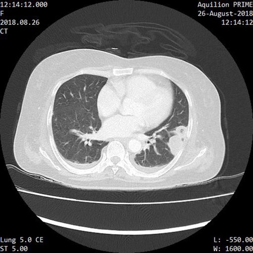 Figure 5 Axial CECT lung window showing well-defined subpleural nodules with central cavity and feeding vessel. Minimal bilateral pleural effusion noted.