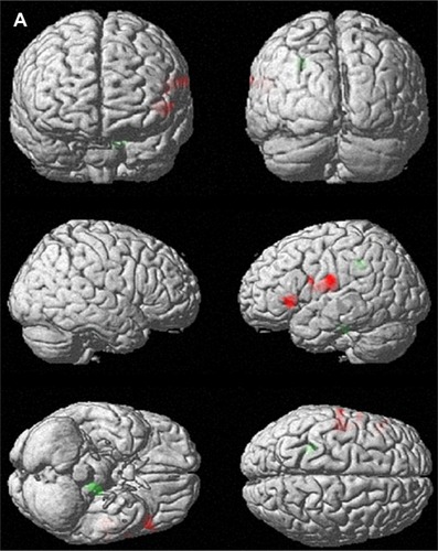 Figure 1 Brain areas with changes in regional cerebral blood flow (rCBF) after 12 weekly sessions of group cognitive behavioral therapy in patients with panic disorder (n=14). (A) 3D-rendered images of rCBF changes. Red, increased rCBF; green, decreased rCBF. (B) Red, areas of increased rCBF, postcentral gyrus of left parietal lobe, precentral gyrus of left frontal lobe and inferior frontal gyrus of left frontal lobe; blue, areas of decreased rCBF, sub-gyral white matter of left limbic lobe and pons.