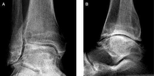 Case no 2. The right ankle preoperatively. This man had his right ankle and left knee replaced during the same anesthesia, at the age of 60. The following year his left ankle and right hip were replaced, also during the same anaesthesia. Pain and swelling of the knee started at the age of 40, but 13 years later it was first confirmed that he suffered from hemochromatosis. The ankles became symptomatic at the age of 42. Reduction of the joint space is seen anteriorly and laterally and there are osteophytes, notably anteriorly at the neck of the talus and distal tibia. Bony eburnation and cysts in the talus and distal tibia can also be seen.