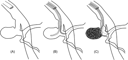 Figure 1. Drawings of the sequential technique used in balloon-assisted coiling. After the catheterization of the main vessel (A), balloon catheter is placed across the aneurysm neck and then the coil delivery microcatheter is placed inside the aneurysm (B). The balloon is inflated during coil insertion to prevent coil protrusion into the vessel lumen and microcatheter kick-out, and to provide sufficient coil packing (C).