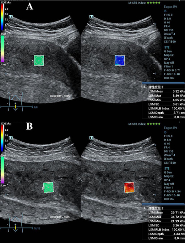 Figure 1 Myometrial shear wave elastography (SWE) images from a healthy pregnant female, age 36. (A) Anterior myometrial SWE (5.32 kPa). (B) Posterior myometrial SWE (26.71 kPa).