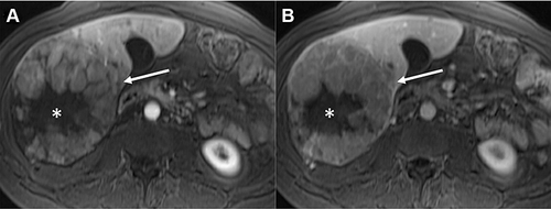 Figure 2 Radiological imaging of MTM-HCC. MR images in a 39-year-old woman with 13-cm heterogeneous macrotrabecular-massive hepatocellular carcinoma (MTM-HCC) in right liver lobe (arrow). Note the presence of a large central area without enhancement on late arterial (A) and venous (B) phases images, corresponding to substantial necrosis (*). Figure provided courtesy of Sébastien Mulé.