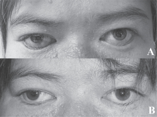 Figure 2 Figure 2A The patient shows 5-mm right and 4-mm left retractions from the lower corneal limbi with proptosis of 26 mm OU. Just the right lower eyelid took two Hotz procedures for the lower eyelid entropion.Figure 2B After lower eyelid lengthening surgery, the right lower eyelid retraction and cicatricial entropion are sufficiently improved.