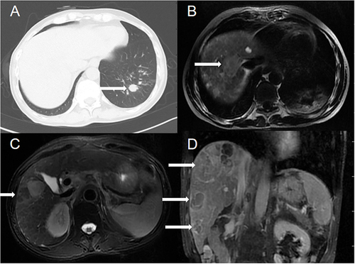 Figure 1 Chest CT and abdominal MRI showed left lung and multiple liver masses (A–D). (white arrow indicate lung and liver masses).