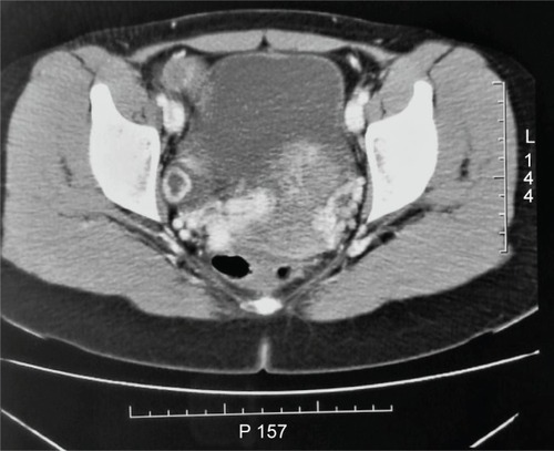 Figure 2 CT scan shows a uterus with slightly increased volume with innumerable, coarse, and serpiginous vascular ectasia in the peripheral muscle tissue.