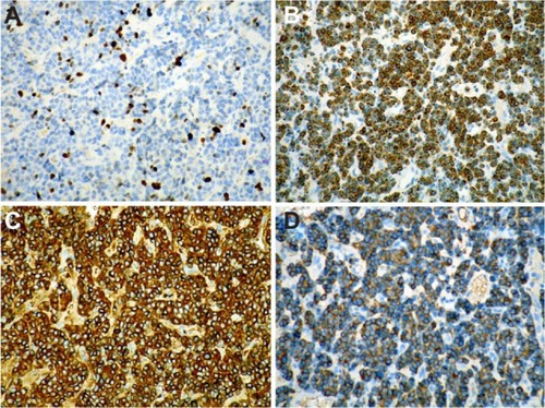 Figure 3 (A–D) Immunohistochemical staining of the biopsied specimen. Immunohistochemical staining was positive for Ki-67 (A), CD56 (B), chromogranin A (C), and synaptophysin (D), demonstrating sustentacular cells around the periphery of the cell nests and supporting the diagnosis of paraganglioma (immunohistochemistry, EnVision).