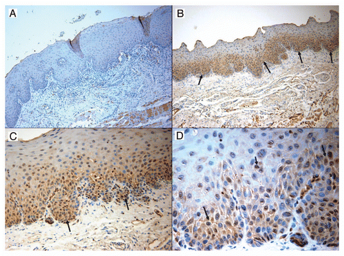 Figure 3 CIP2A expression by immunohistochemistry of oral dysplasia. Photomicrograph part for epithelial dysplasia: Figure A. Control specimen representing oral hyperkeratosis sample demonstrating only sporadic positive cells (magnification x10). Figure B. Strong reactivity for CIP2A noted in the basal and parabasal cells (black arrows) in sample from mild to moderate epithelial dysplasia (magnification X10). Figure C. Another sample of mild to moderate epithelial dysplasia displaying with numerous CIP2A positive cells at the basal and parabasal levels (magnification x20) (black arrows) Figure D. Higher magnification (x40) from previous case (C) exhibiting strongly positive CIP2A cells with prominent nuclear and lighter cytoplasmic staining (black arrows).