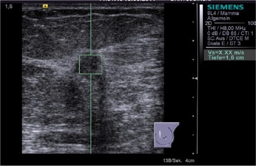Figure 4 ARFI VTTQ of a malignant breast lesion (invasive ductal breast cancer). This measurement was unsuccessful (displayed as “X.XX m/s”) and had to be repeated, according to the study protocol.